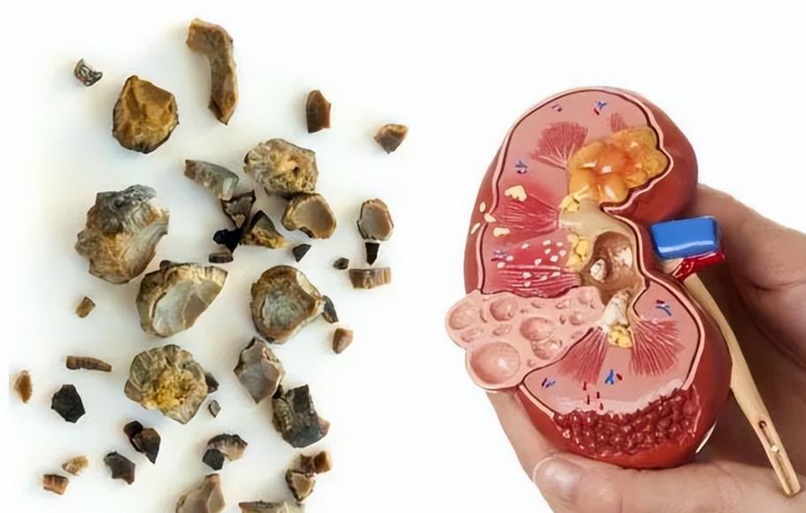 提醒：体内有结石的人，尽量少吃6种&ldquo;发物&rdquo;，忍住不吃或有帮助