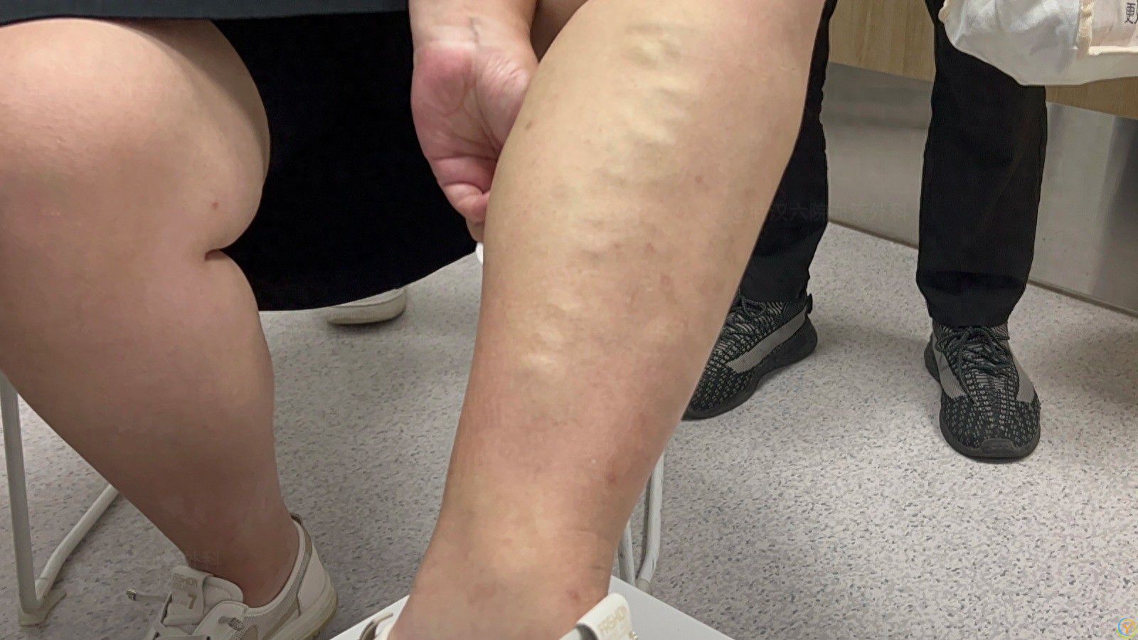 人不会无缘无故得血管病，容易静脉曲张的，背后多少有这几个原因